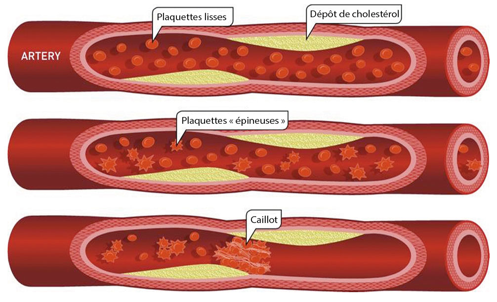 artere_cholesterol