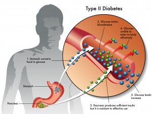 Diabete tipo 2