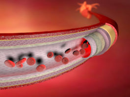 Du dysfonctionnement érectile… à l’infarctus du myocarde ! (partie 1/4)