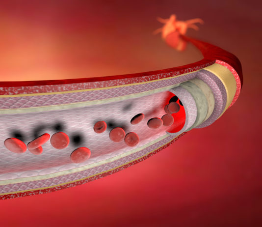 Du dysfonctionnement érectile… à l’infarctus du myocarde ! (partie 1/4)
