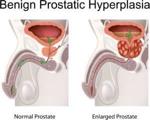 Benign prostatic hyperplasia (prostatic hypertrophy)