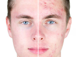 La nutrition anti-acné