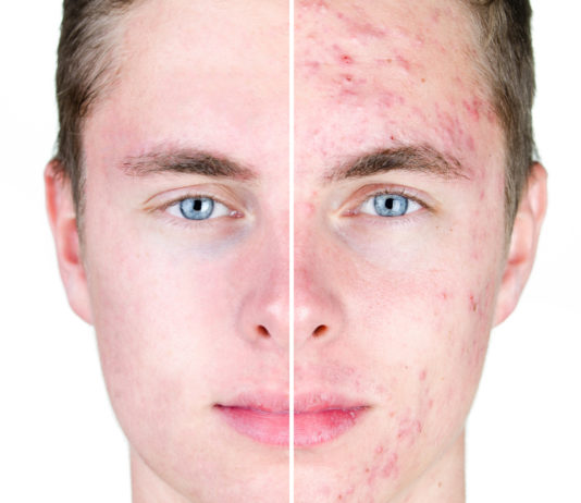 La nutrition anti-acné