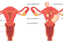 La nutrithérapie contre les fibromes utérins La nutrithérapie contre les fibromes utérins