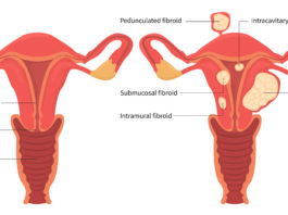 La nutrithérapie contre les fibromes utérins La nutrithérapie contre les fibromes utérins