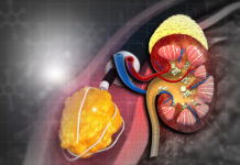 Nutrithérapie et lithiases rénales Nutrithérapie et lithiases rénales