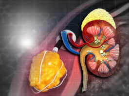 Nutrithérapie et lithiases rénales Nutrithérapie et lithiases rénales