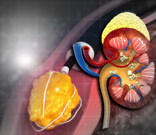 Nutrithérapie et lithiases rénales Nutrithérapie et lithiases rénales